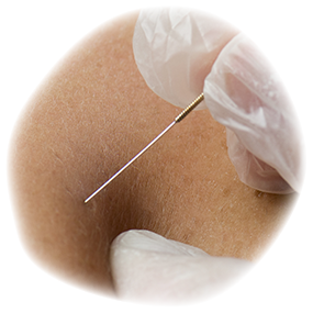 Marie Fisioterapia Punción Seca